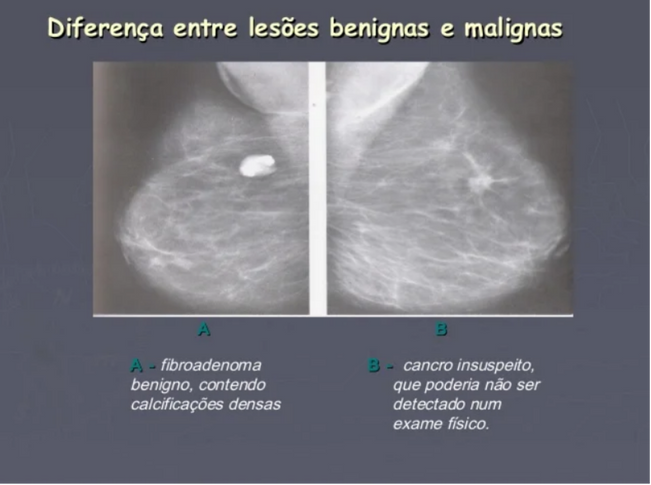 Cancer de mama